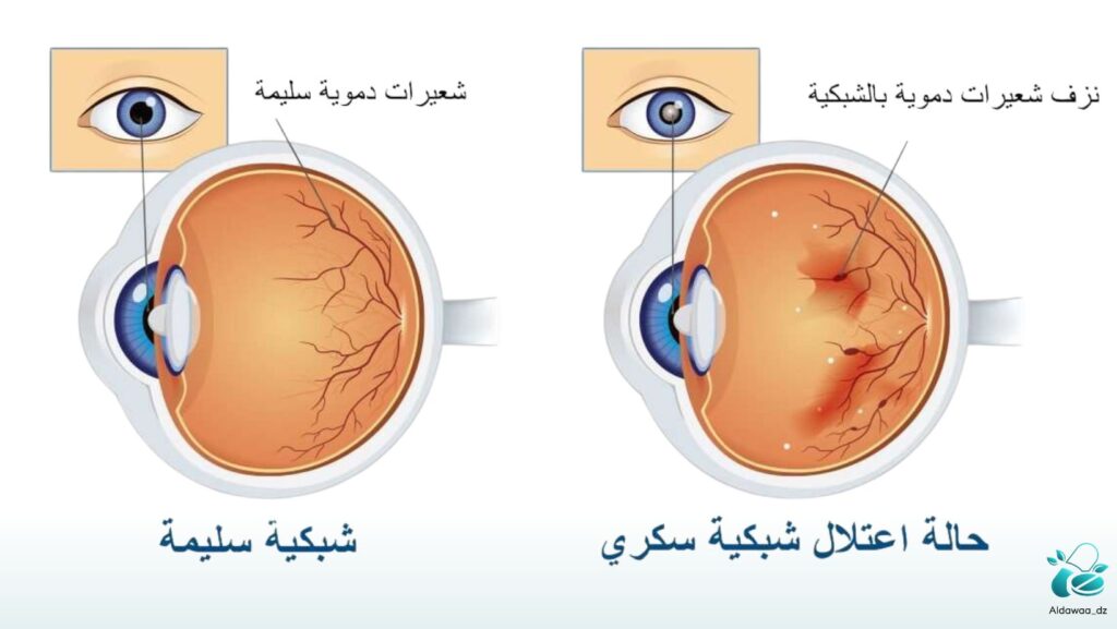 اعتلال شبكية العين لمرضى السكري