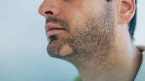 أعراض مرض الثعلبة